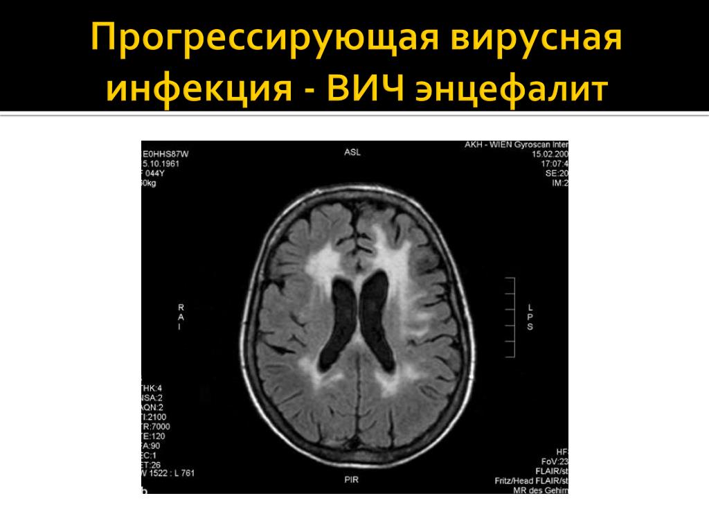 Энцефалит головного мозга у взрослых. Гриппозный энцефалит мрт. Герпетический энцефалит кт. Вирусный энцефалит головного мозга мрт.