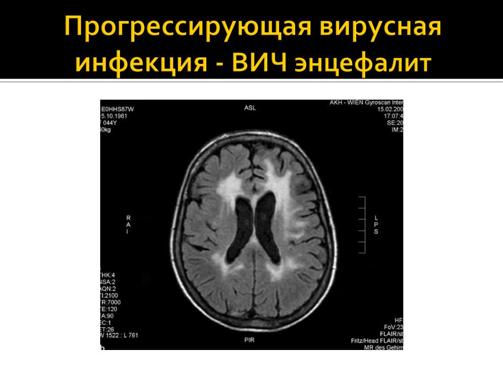 Энцефалит головного мозга у взрослых