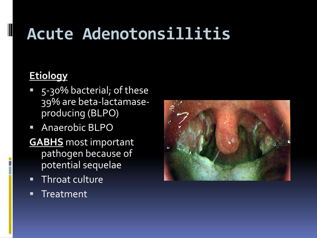 Ppt Tonsillectomy And Adenoidectomy Powerpoint Presentation Free