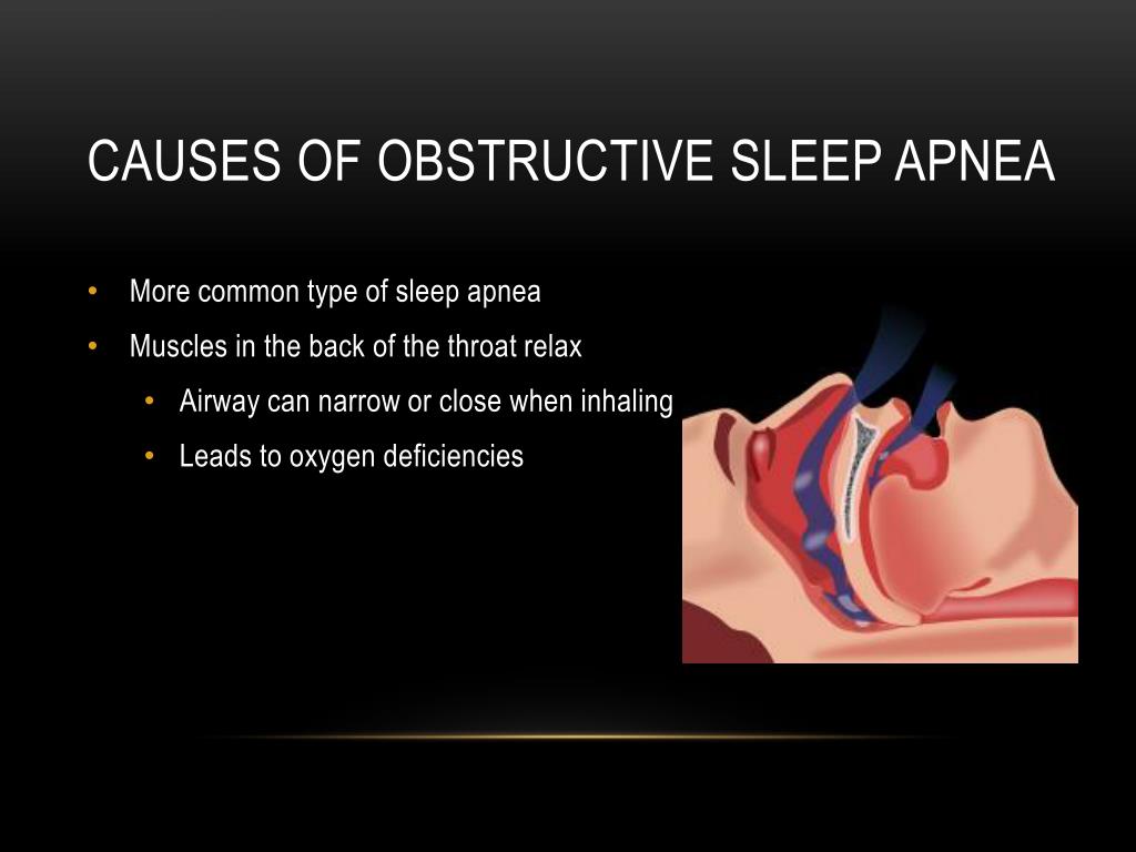 Ppt Sleep Apnea Powerpoint Presentation Free Download Id 6248751