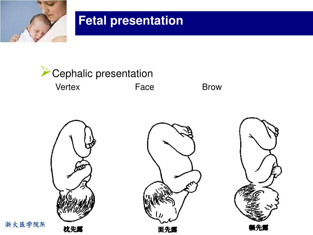 anomalies of fetal cephalic presentation