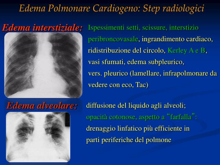Che Cos è L Edema Polmonare PPT - EDEMA POLMONARE ACUTO PowerPoint Presentation - ID:6256703
