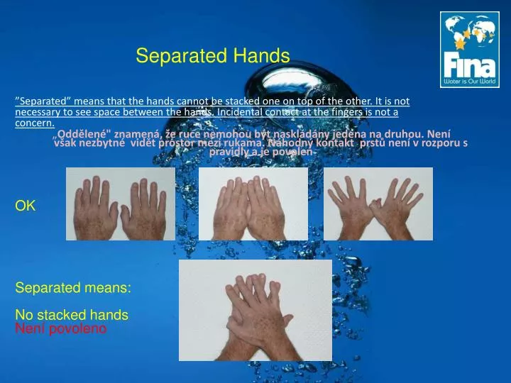 separated hands n.