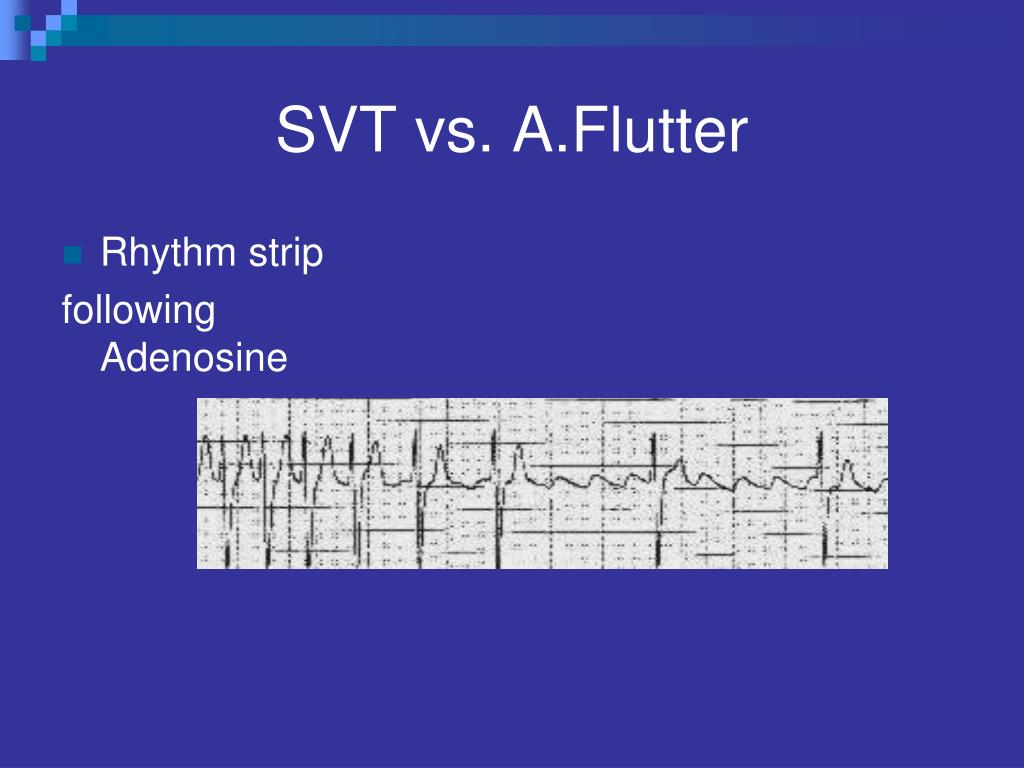 atrial flutter vs svt atrial flutter vs svt