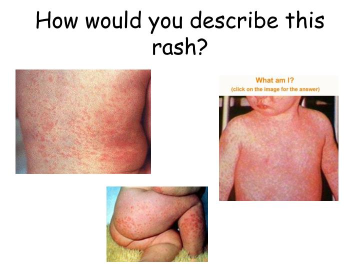rash describe fever would viral syphilis secondary lyme ppt powerpoint presentation syndrome reiter