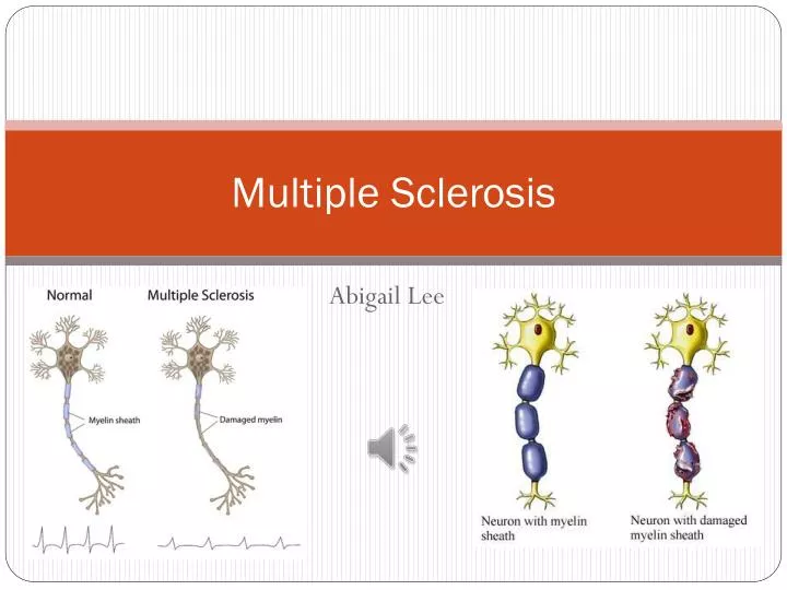 PPT - Multiple Sclerosis PowerPoint Presentation, free download - ID ...