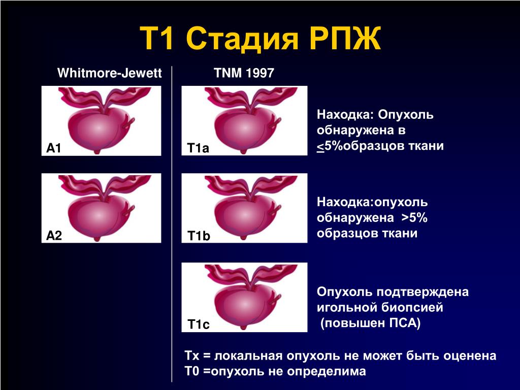 Раз предстательной железы. Классифткациярака предстательной. Опухоли предстательной железы классификация. Классификация TNM простата.