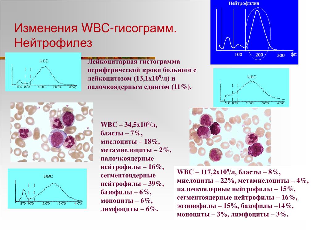 Нейтрофилез. Нейтрофилез характерен для. Нейтрофилез в периферической крови. Относительный нейтрофилез.