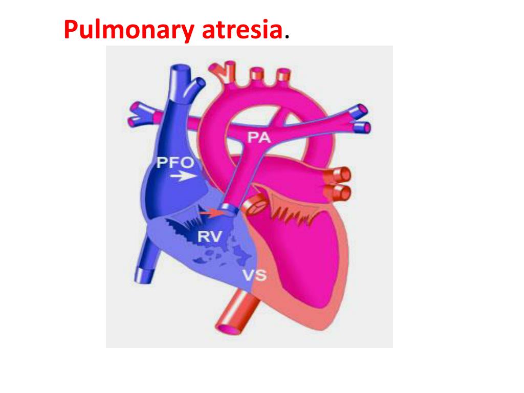 PPT - Congenital cyanotic heart disease PowerPoint Presentation, free ...