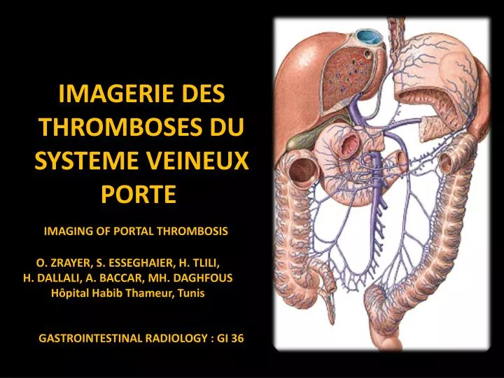 PPT - IMAGERIE DES THROMBOSES DU SYSTEME VEINEUX PORTE ...