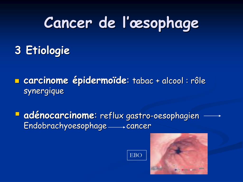 Atresie De Loesophage Esperance De Vie