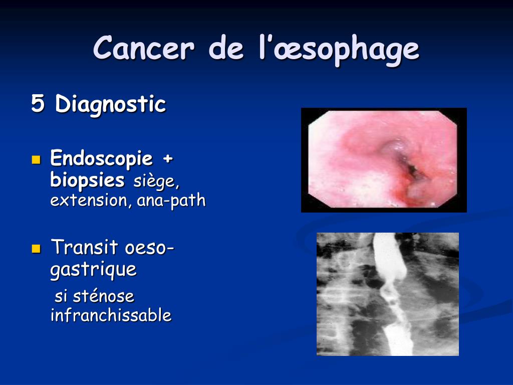 Atresie De Loesophage Esperance De Vie Atrésie De L'oesophage Esperance De Vie - Communauté MCMS