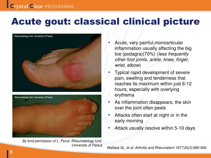 clinical presentation of gout