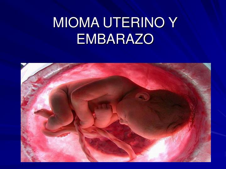 PPT - DIPLOMADO DE ULTRASONOGRAFIA EN OBSTETRICIA Mioma Uterino y Embarazo PowerPoint
