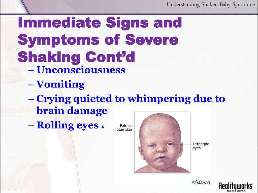 PPT - Shaken Baby Syndrome: PowerPoint Presentation, free ...