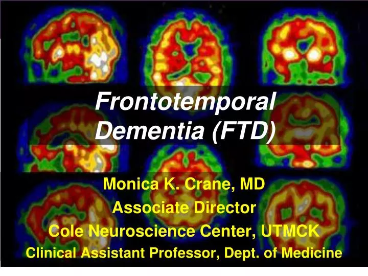 frontotemporal dementia ftd n.