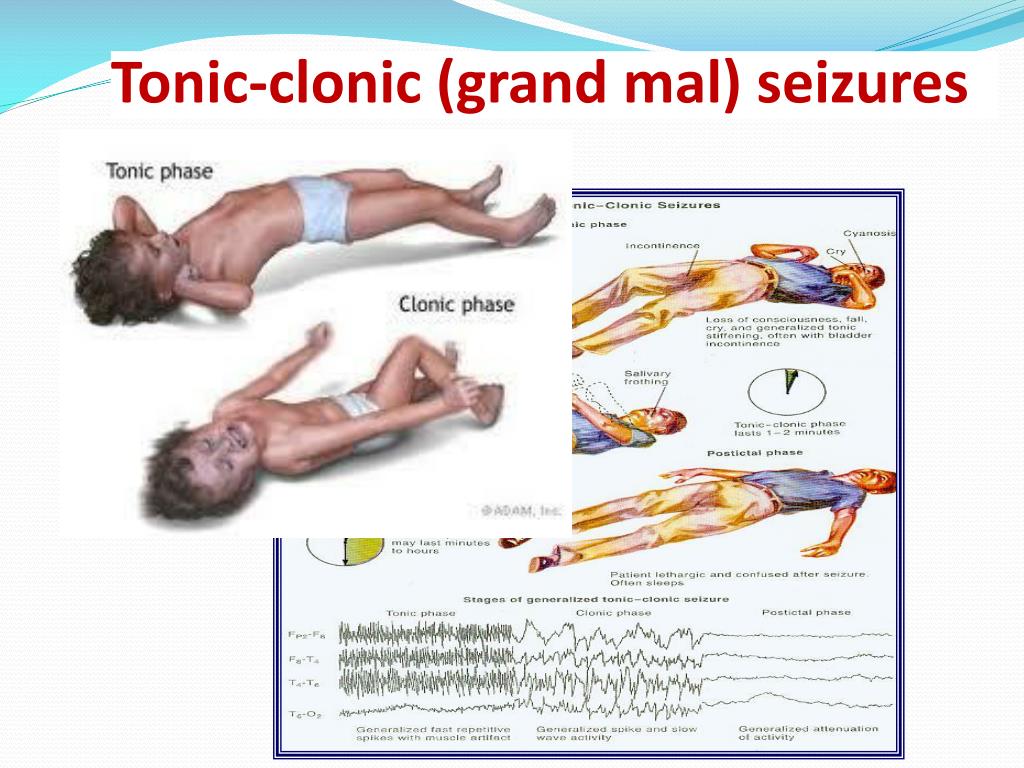 clonic tonic seizures