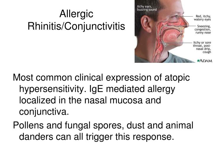 Eye Rhinitis What Causes Allergic Rhinitis And Conjunctivitis? – FQRV