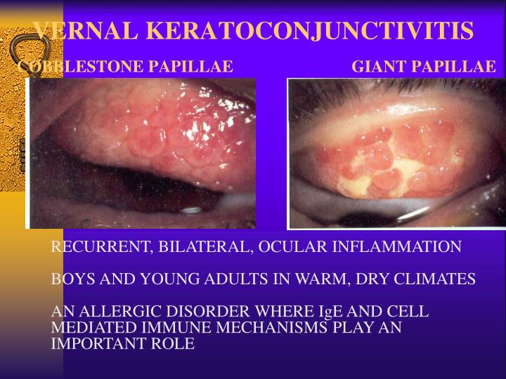 PPT - EPISCLERITIS/ SCLERITIS PowerPoint Presentation - ID 