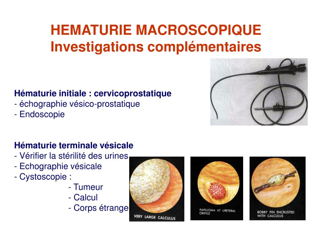 PPT HEMATURIES D finition 2 Diagnostic Positif Reconna tre L PPT HEMATURIES D finition 2 Diagnostic Positif Reconna tre L