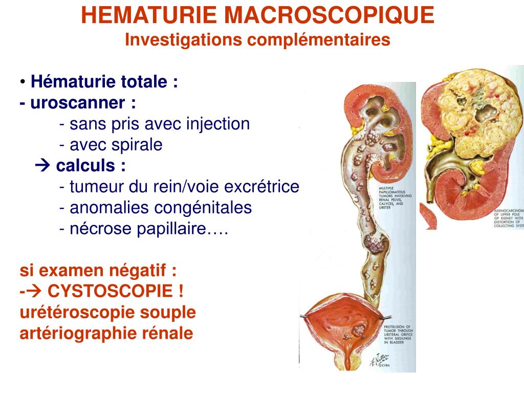 PPT HEMATURIES D finition 2 Diagnostic Positif Reconna tre L PPT HEMATURIES D finition 2 Diagnostic Positif Reconna tre L