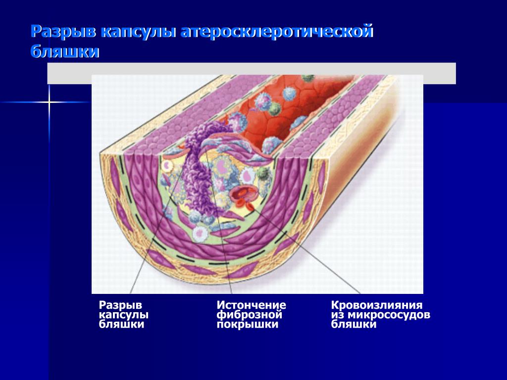 Атеросклероз картинки для презентации. Фиброзная атеросклеротическая бляшка состав.