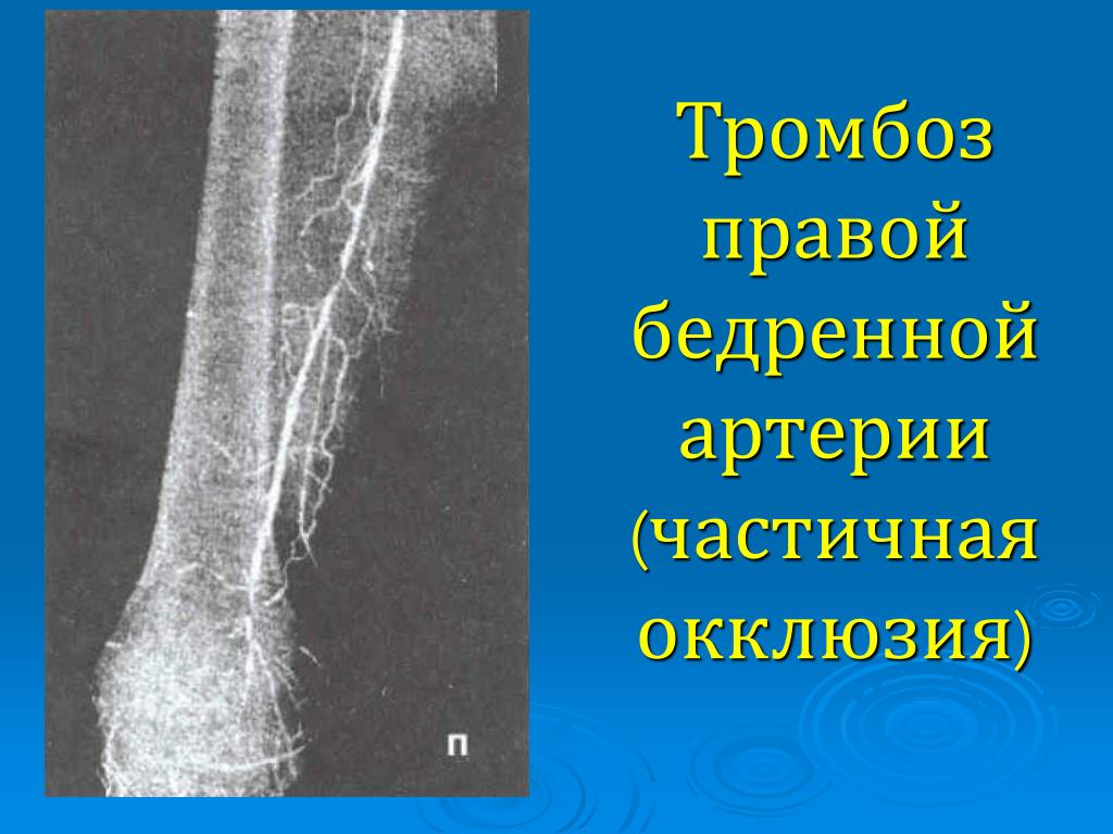 Тромбоз артерий верхних. Флеботромбоз бедренной артерии. Тромбофлебит бедренной артерии. Тромб подколенной артерии. Тромб в бедренной артерии.