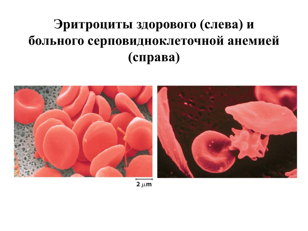 Эритроциты при серповидно клеточной анемии. Серповидноклеточная анемия. Эритроциты. Анемия эритроциты здорового и больного. Эритроциты при серповидноклеточной анемии.