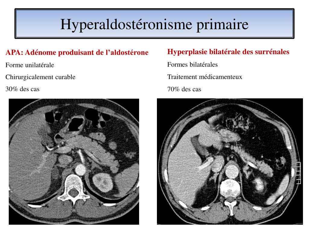 PPT - HTA résistante : diagnostic et prise en charge en 2014 PowerPoint ...