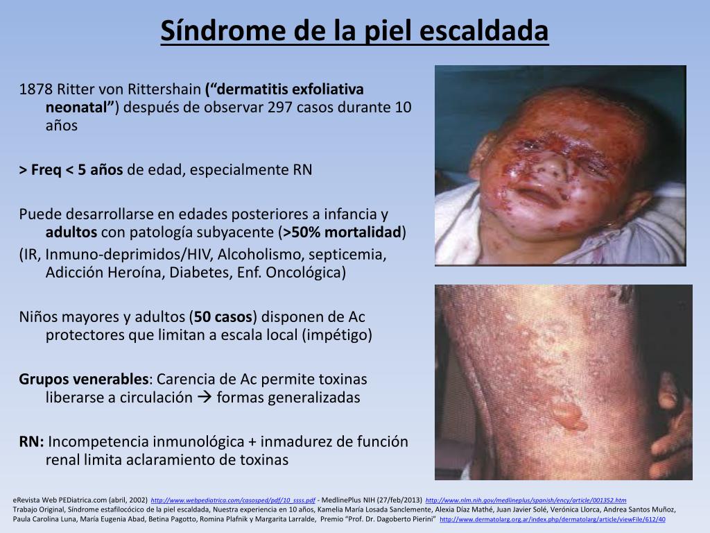 que produce la piel escaldada que produce la piel escaldada