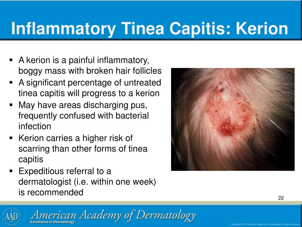PPT Pediatric Cutaneous Fungal Infections PowerPoint Presentation