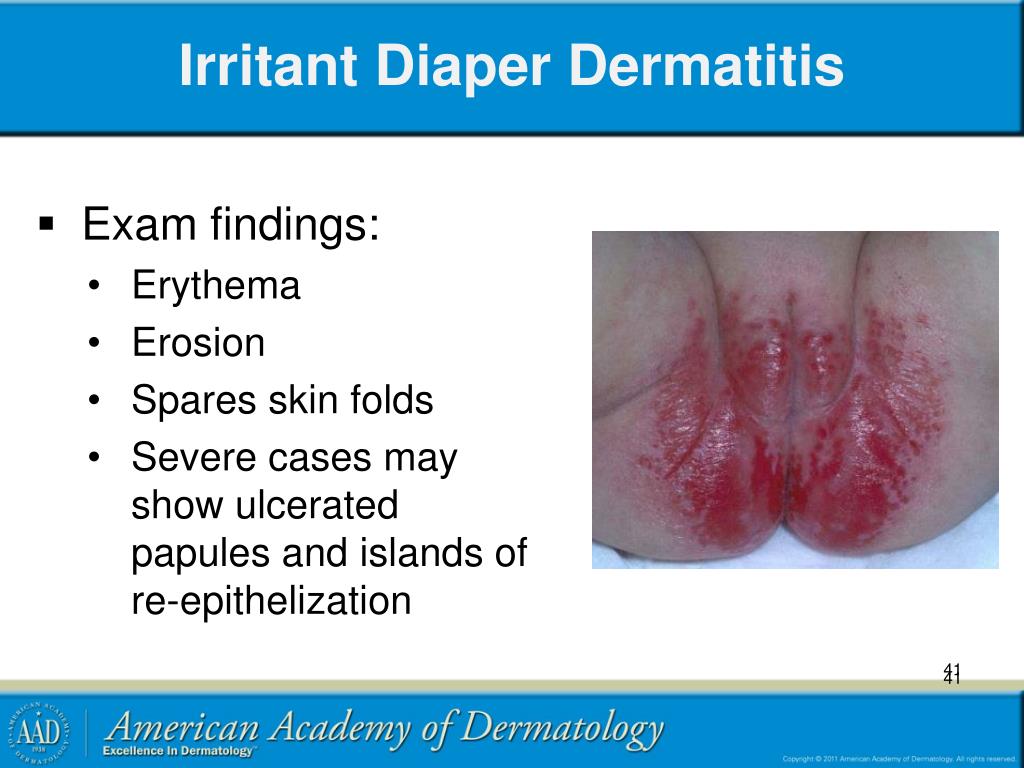 PPT - Pediatric Cutaneous Fungal Infections PowerPoint Presentation