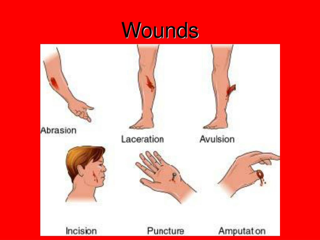 Injured Meaning