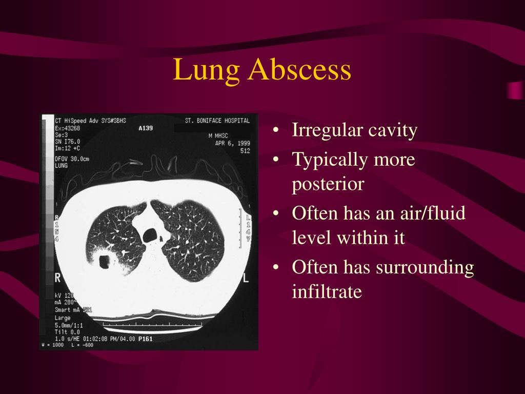 case study on lung abscess slideshare