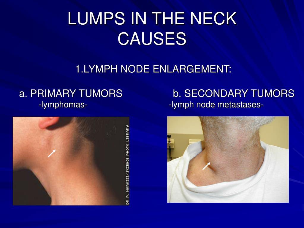 Lymph Node Lump On Neck
