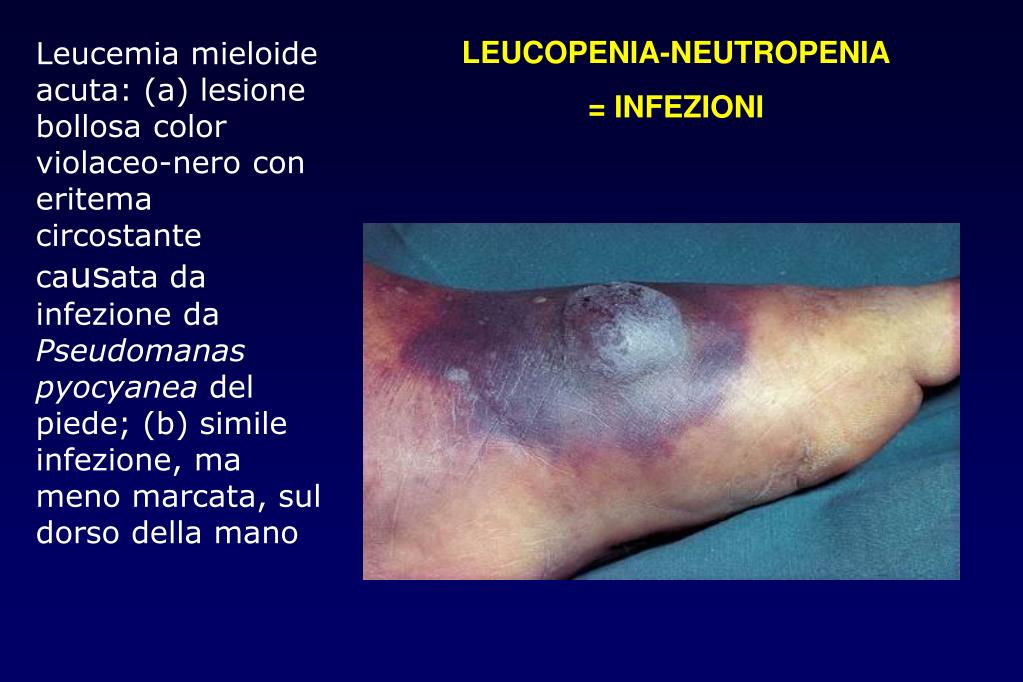 PPT - DIAGNOSI E TERAPIA DELLE LEUCEMIE ACUTE e DELLE ...