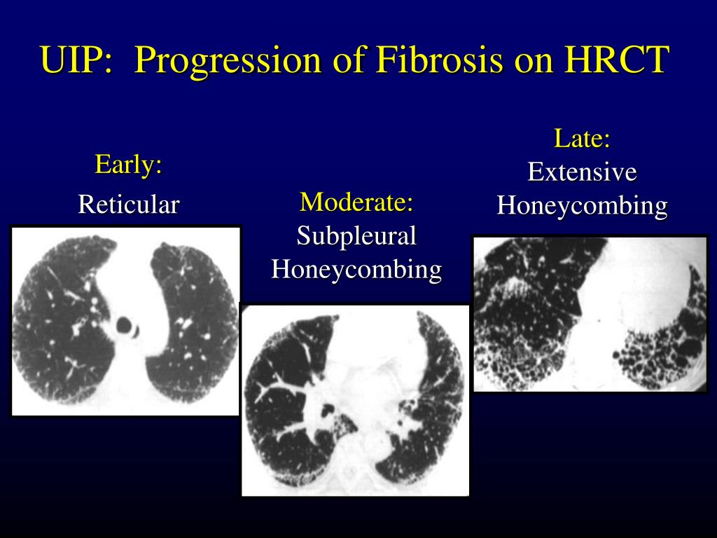 Ppt Biopsy Is Necessary For The Diagnosis Of Ipf Powerpoint