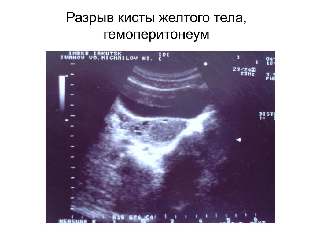Киста желтого тела задержка. Апоплексия кисты желтого тела на УЗИ. Разрыв жёлтого тела на УЗИ. Разрыв кисты желтого тела яичника.