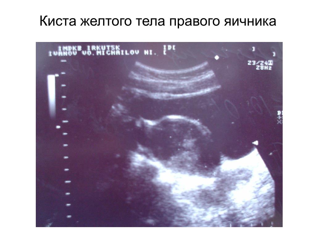 Киста желтого тела задержка. Киста желтого тела яичника на УЗИ. Киста желтого тела в правом яичнике. Жёлтое тело в правом яичнике на УЗИ. Кистозное желтое тело в правом яичнике.
