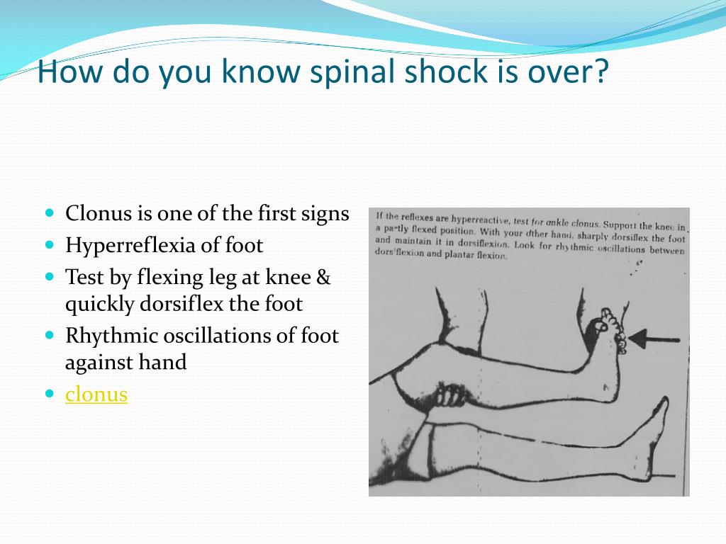 Клонус это. Spinal Shock. Spinal Shock Symptom.