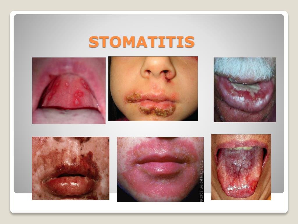 PPT Medical English Stomatitis PowerPoint Presentation, free download ID6570113