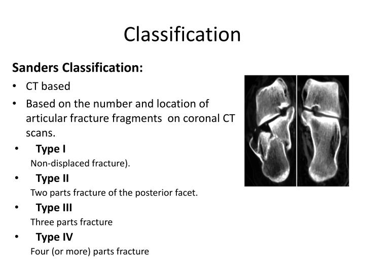 PPT Calcaneal Fractures PowerPoint Presentation ID6578166