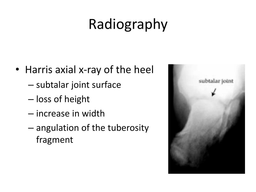 Figure 5 from Measurement technique of calcaneal varus from axial view  radiograph | Semantic Scholar
