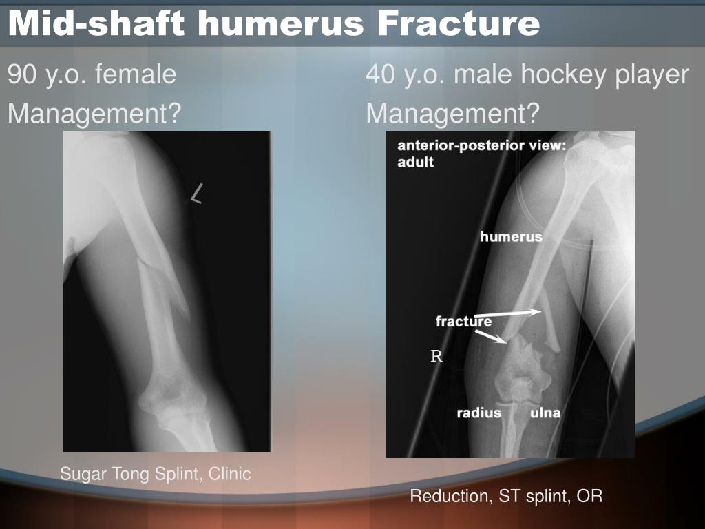 PPT - Applied ER Ortho: Upper Limb Fractures “Tips and ...