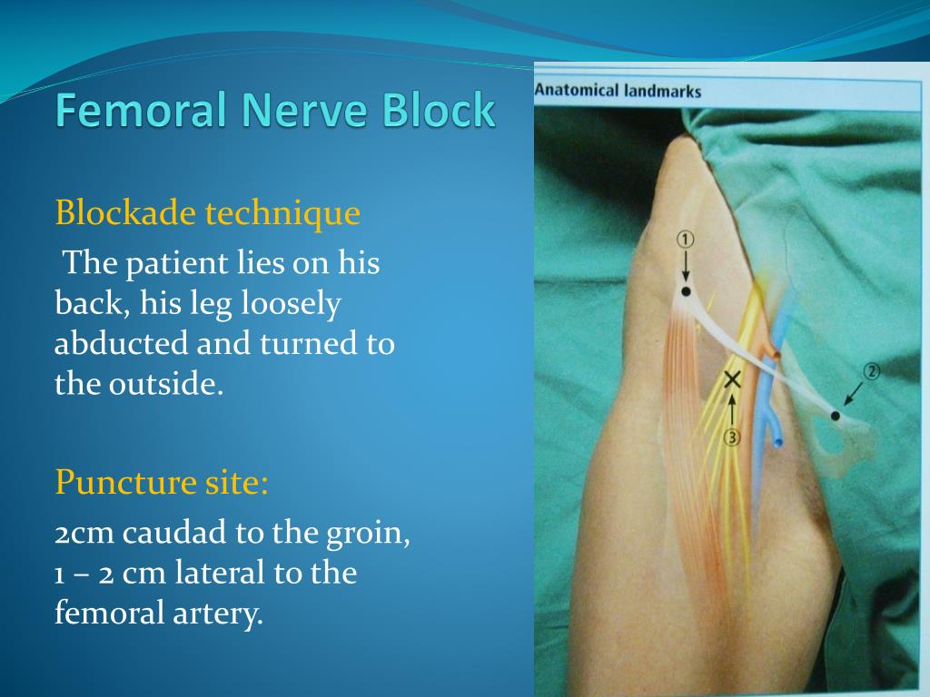 Lateral Femoral Nerve Block