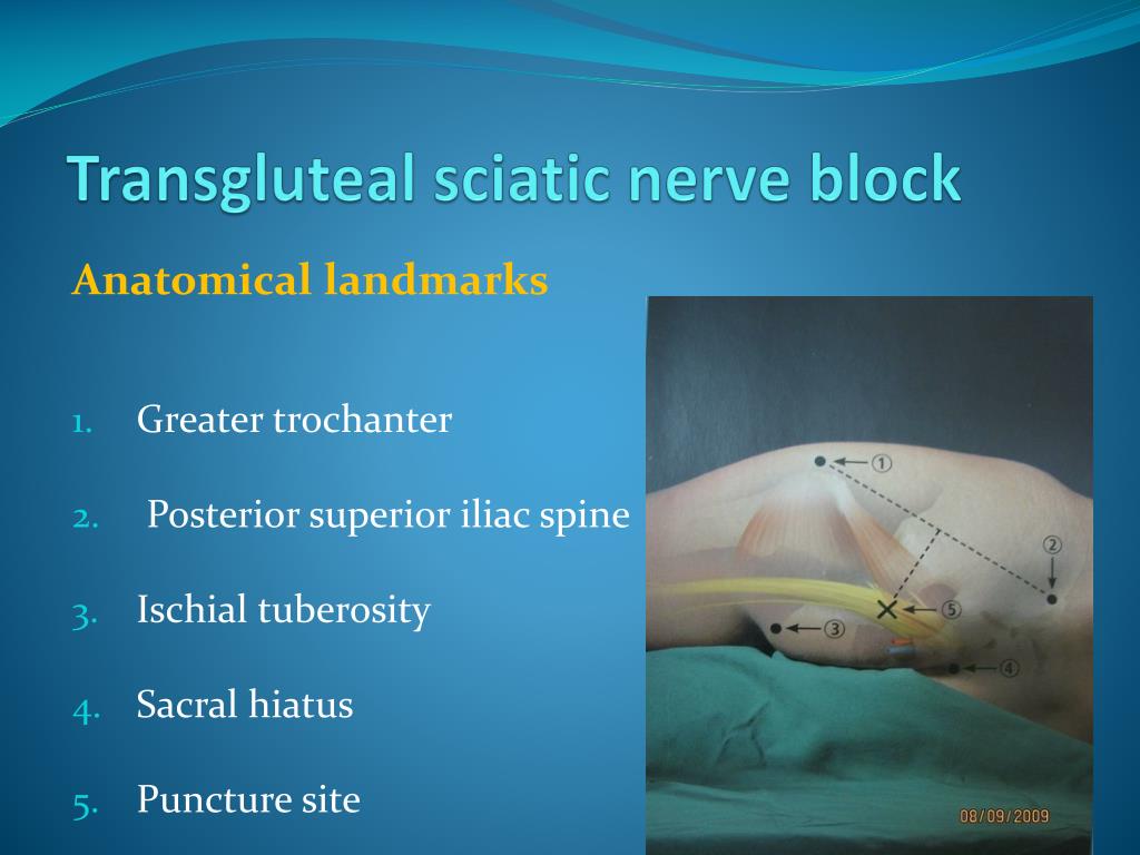 PPT Peripheral Nerve Blocks using Nerve Stimulator PowerPoint Presentation ID6587417