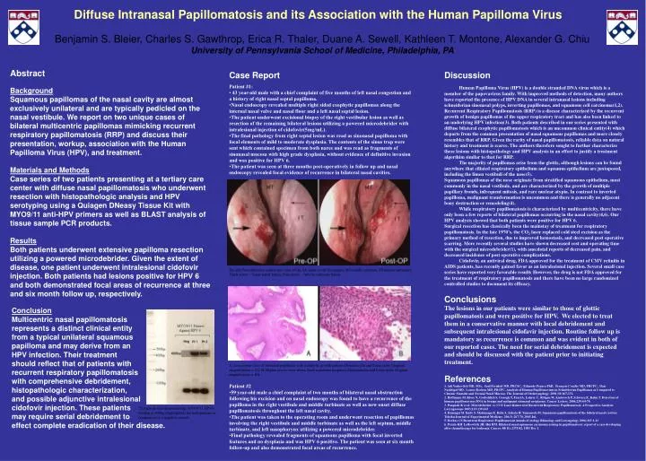 squamous papilloma nasal cavity)