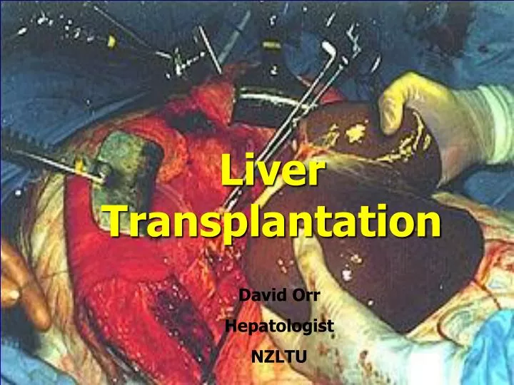 liver transplantation for alcoholic liver disease n.