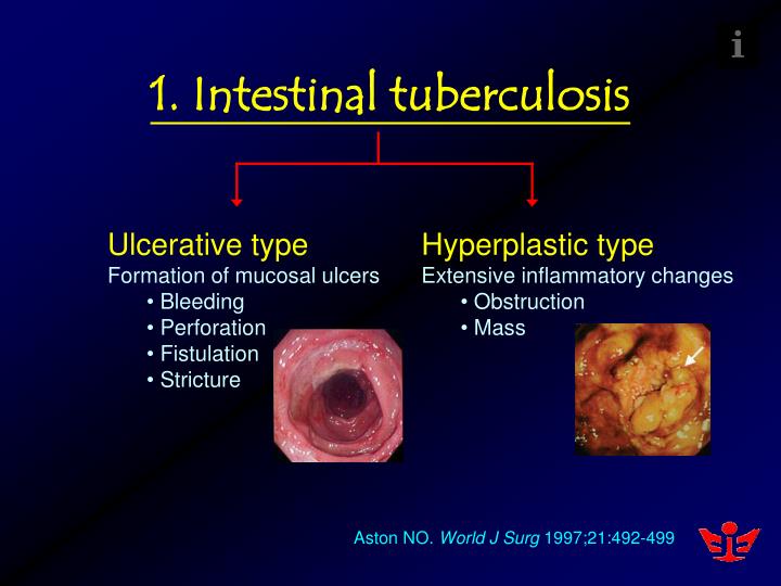 PPT - Management Of Abdominal Tuberculosis Joint Hospital Surgical ...