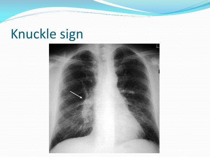 PPT Pulmonary Embolism PowerPoint Presentation ID6594617